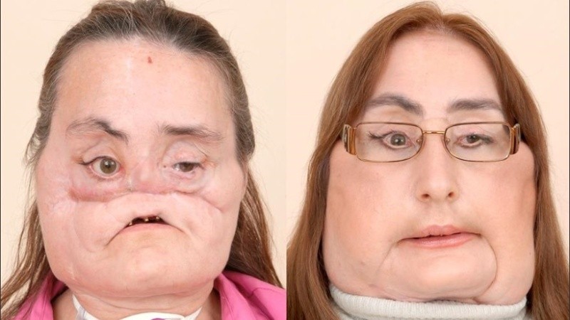 Connie Culp perdió parte del rostro después de que su esposo le disparó en 2004.