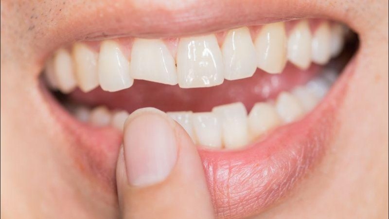El bruxismo no es un trastorno peligroso, pero si no se corrige puede causar lesiones dentales permanentes