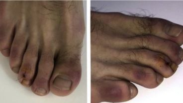 Se trata de una inflamación similar a un sabañón.