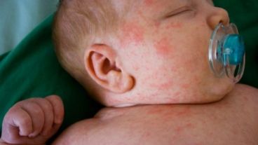 Una de las reacciones de la APLV en lactantes.