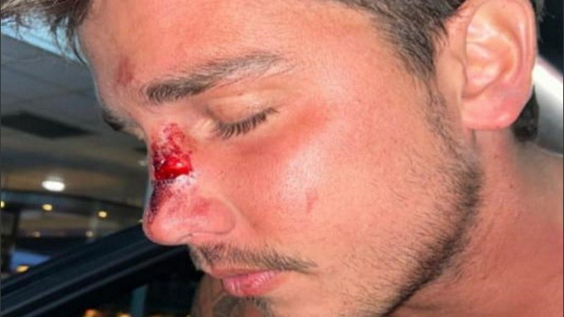 El chico sufrió una fractura en su nariz tras ser golpeado, según denunció ante la Policía. 