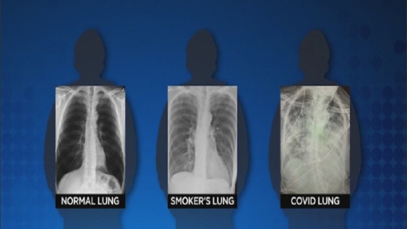 Las radiografías compararon los pulmones de una persona sana, otra fumadora y otra que tuvo coronavirus. 