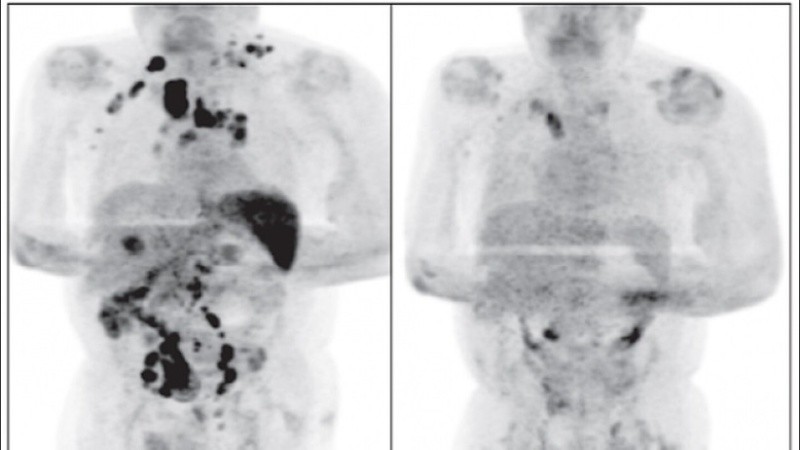 Los médicos compararon dos tomografías, tomadas antes y después de que el paciente se contagiara de coronavirus. 