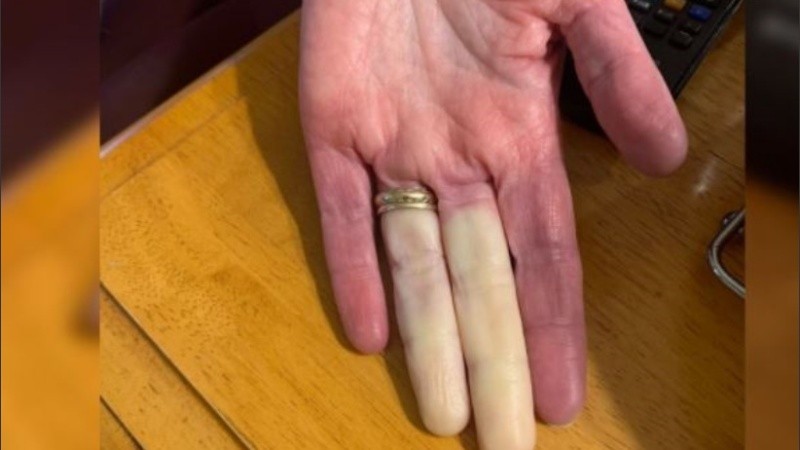El Fenómeno de Raynaud es más frecuente en personas que viven en climas fríos.