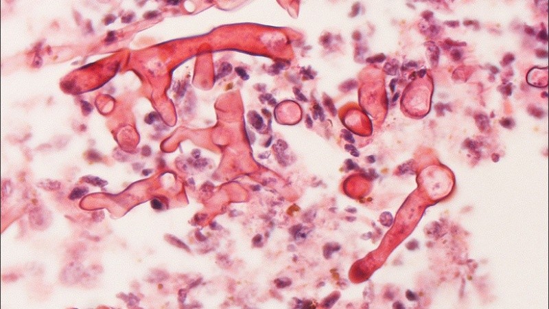 Una imagen microscópica de mucormicosis.