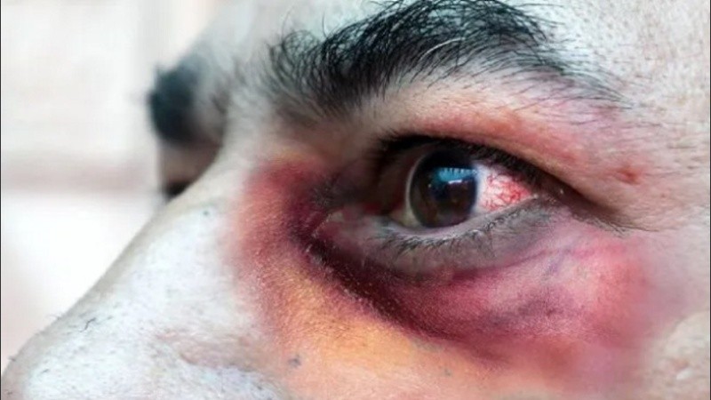 Los pacientes inmunosuprimidos graves son más propensos a detener infecciones por agentes oportunistas, entre ellos hongos. El mucormicosis es uno de ellos.