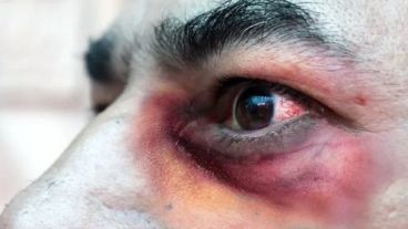 Los pacientes inmunosuprimidos graves son más propensos a detener infecciones por agentes oportunistas, entre ellos hongos. El mucormicosis es uno de ellos.