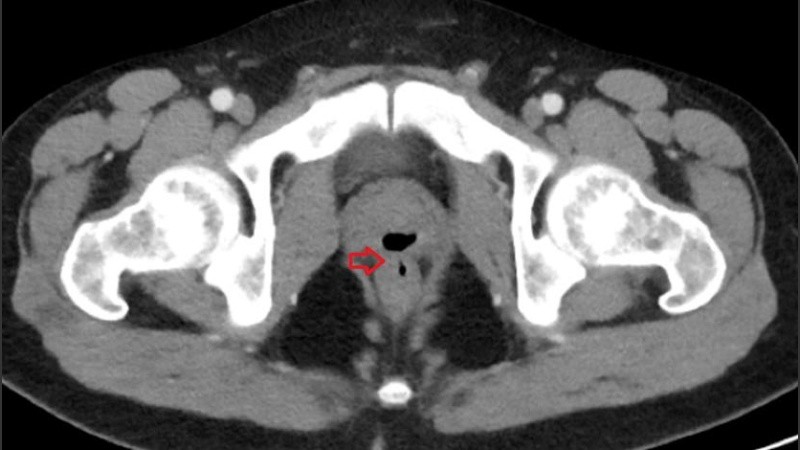 Imagen de la lesión del paciente, un hombre de 33 años.
