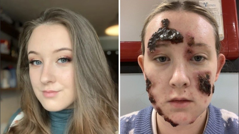 La joven se encuentra en recuperación.