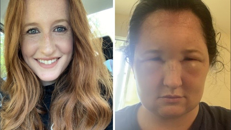 La mujer tardó semanas en recuperarse.