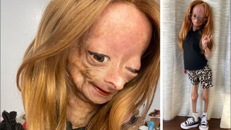 La joven logró vivir hasta los 15 años pese a su rara condición genética.