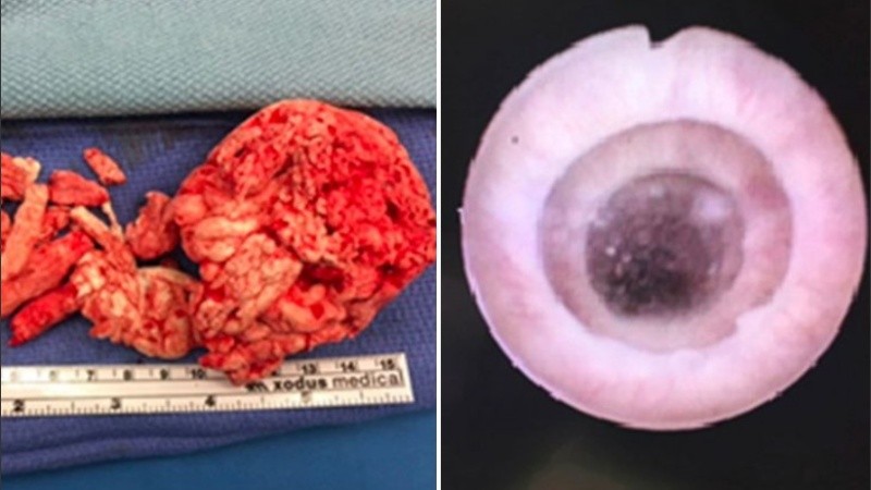 El hombre debe someterse a más operaciones para recuperar su pene.