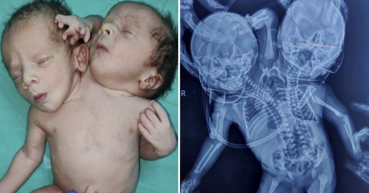 Fotos nació un bebé con dos cabezas y tres brazos y no saben si podrán