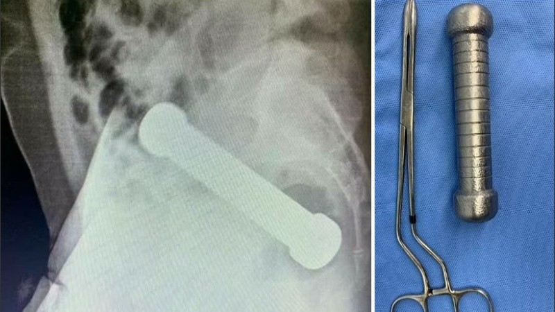 Esperan que el hombre no sufra complicaciones a largo plazo.