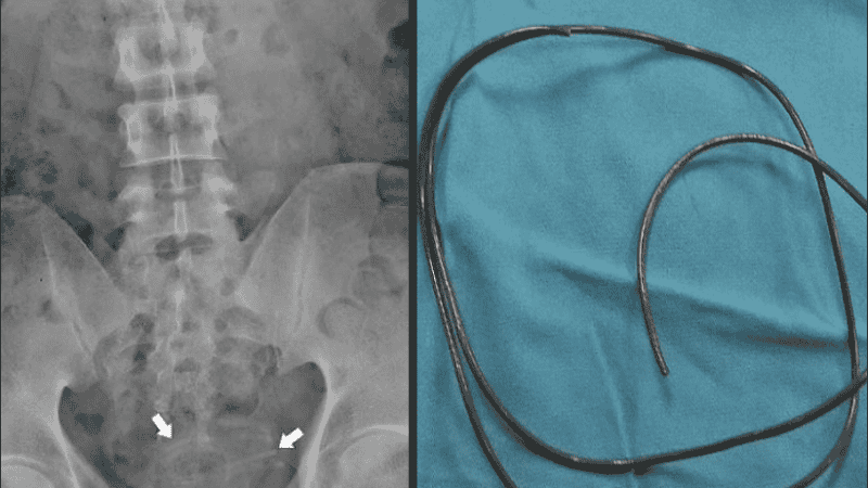 Se trata de un comportamiento de alto riesgo que a menudo resulta en infecciones.