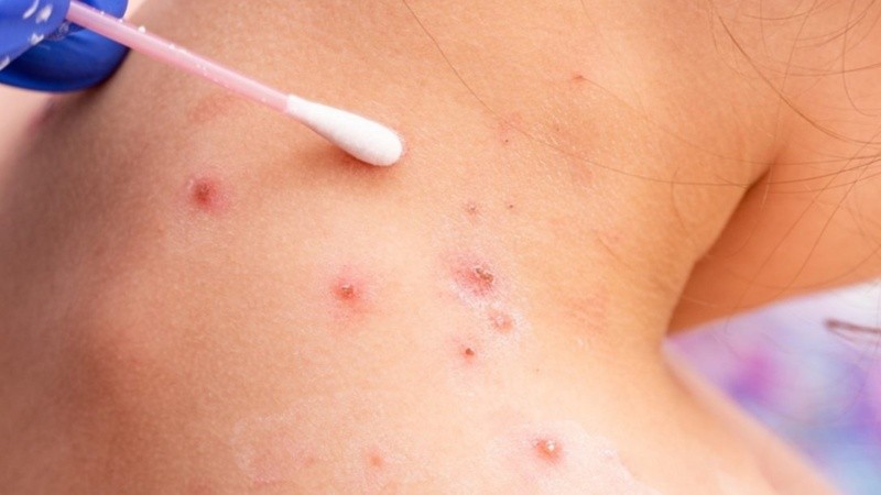 La OMS analiza los casos ya confirmados.