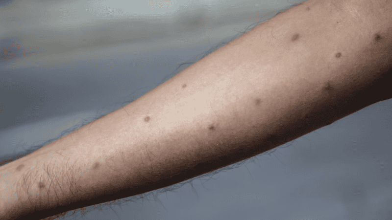 Los síntomas de esta enfermedad pueden generar erupciones cutáneas.