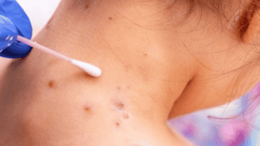 El brote sorprendió a los especialistas aunque no sería muy contagioso entre personas.