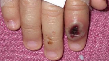 La mano de un niño con la viruela.