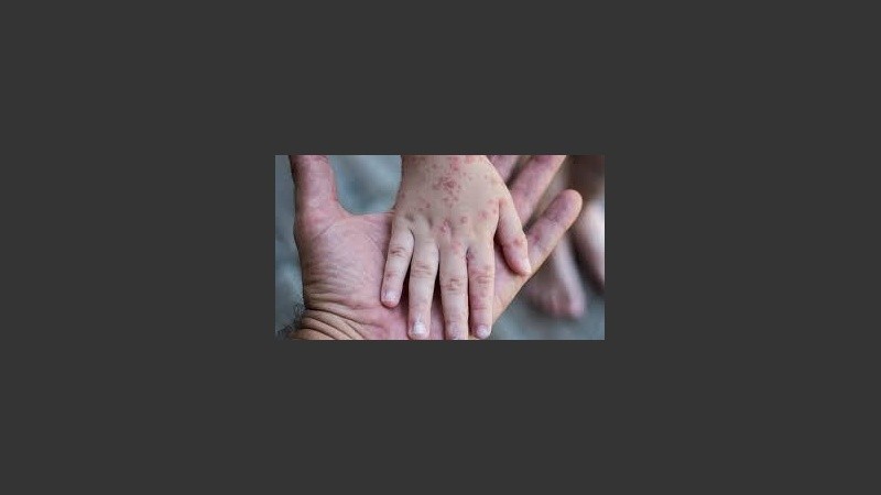 “Habitualmente es una infección que desaparece sola