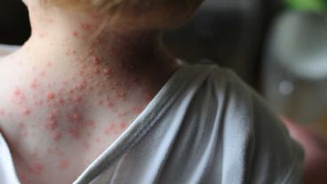 Preocupa el avance de la viruela del mono por fuera de la zona endémica.