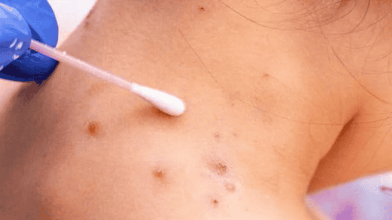 En todo el mundo ya se confirmaron 300 casos de esta enfermedad.