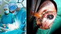 Un médico extrajo accidentalmente el ojo bueno de un paciente durante una operación y lo dejó ciego