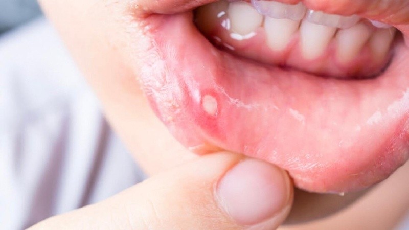 Remarcan la importancia de la consulta médica frente a la aparición de “llagas y vesículas (lesiones con líquido), crecimiento de tejido en la boca o verrugas después de mantener relaciones sexuales sin protección”.