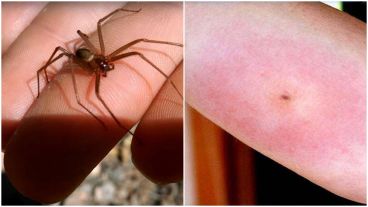 La "araña del rincón" y la marca que deja en la piel.
