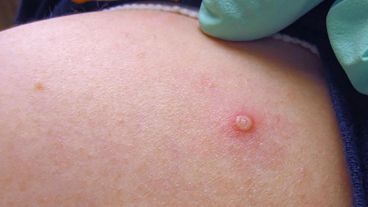 El último reporte del Ministerio de Salud de la Nación informó un aumento de los casos en el país.