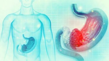 La gastritis erosiva requiere un diagnóstico endoscópico que permita observar si hay inflamaciones, erosiones y sangrado.