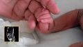 México: una bebé nació con una cola cubierta de piel y pelos que medía seis centímetros
