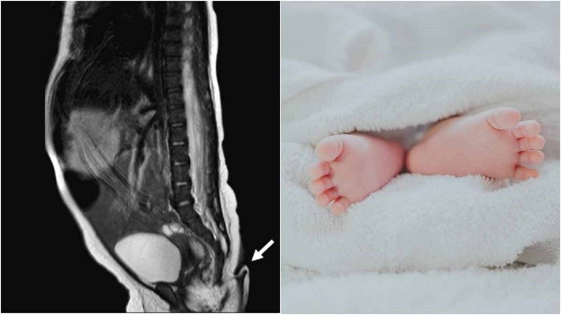 Al notar un leve crecimiento de la cola un mes después del nacimiento, los médicos decidieron cortarla.