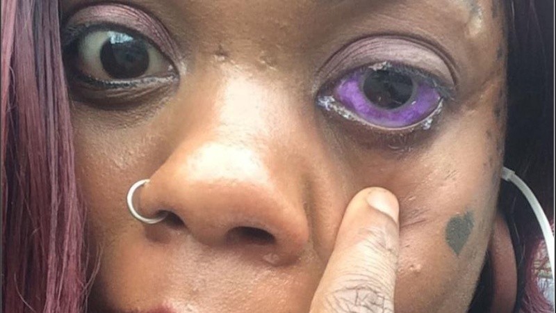 Peterson, de 32 años, podría perder la vista para siempre.