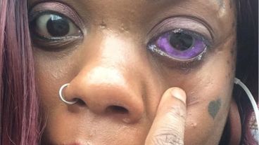 Peterson, de 32 años, podría perder la vista para siempre.