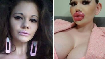 La joven también se sometió a una operación de aumento de senos XL.