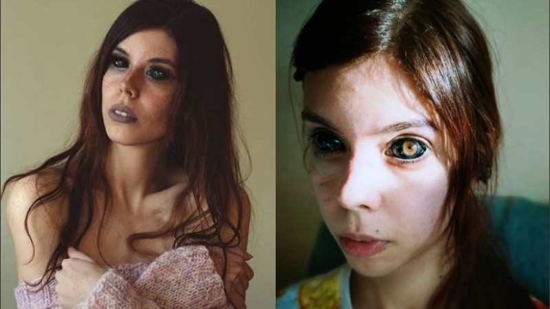 Uno de sus ojos tuvo que ser reemplazado con un implante.