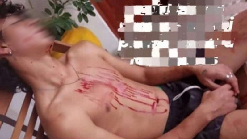 Así quedó Salvador, el adolescente de 16 años que sufrió fractura de maxilar por la agresión