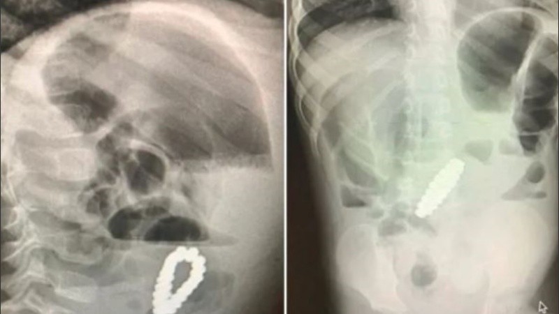 El niño se recuperó rápidamente y fue dado de alta.