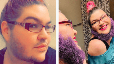 La joven tiene síndrome de ovario poliquístico.