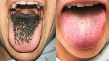 La mujer logró recuperarse tras dejar el medicamento.