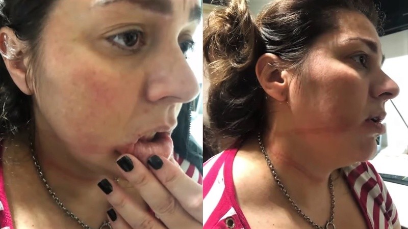 La víctima quedó con marcas en todo el cuerpo por el atroz ataque de este miércoles.