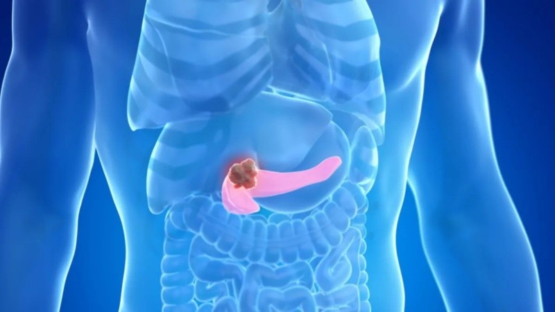 El cáncer de páncreas es el quinto tipo de cáncer con mayor frecuencia en Argentina 