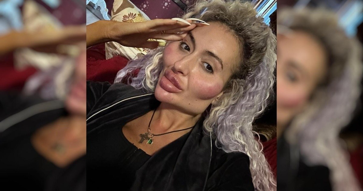 La mujer con "los pómulos más grandes del mundo" sumó una nueva cirugía