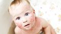 La dermatitis atópica es el problema de piel más frecuente en niños.