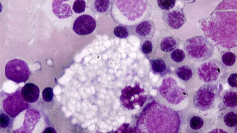 Puede tener presentación neonatal, infantil, juvenil o adulta.