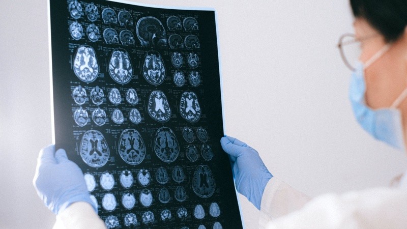 Es la forma más común de demencia y posiblemente representa del 60% al 70% de los casos de demencia neurodegenerativa.