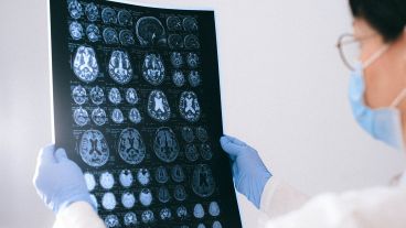 Es la forma más común de demencia y posiblemente representa del 60% al 70% de los casos de demencia neurodegenerativa.