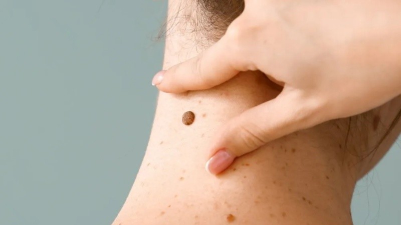 El cáncer de piel es el más común y el que mayor posibilidad de cura tiene si se detecta a tiempo.
