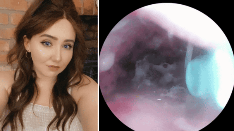 Los médicos lograron sacar el nido de arañas de su oído.